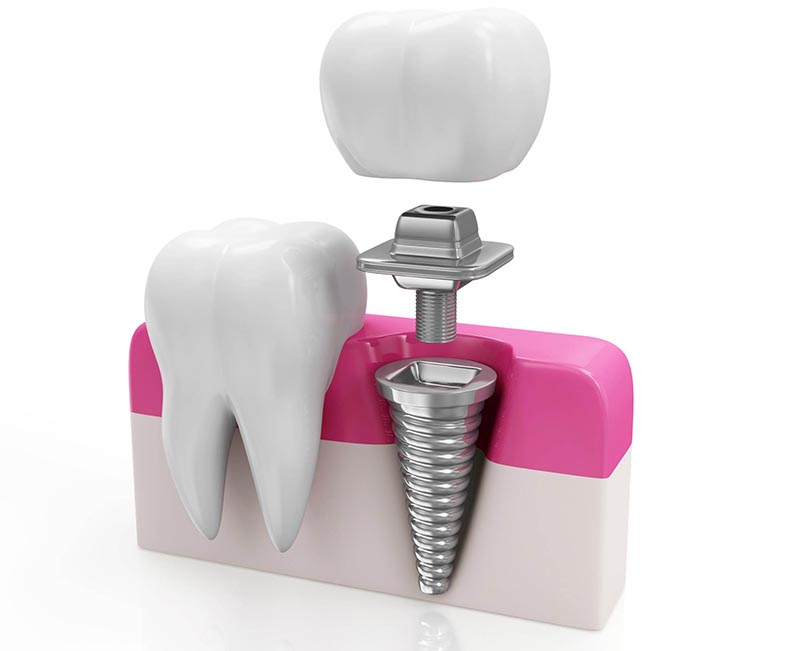 Dental Implant Antalya, Tooth Implant Antalya,Turkey